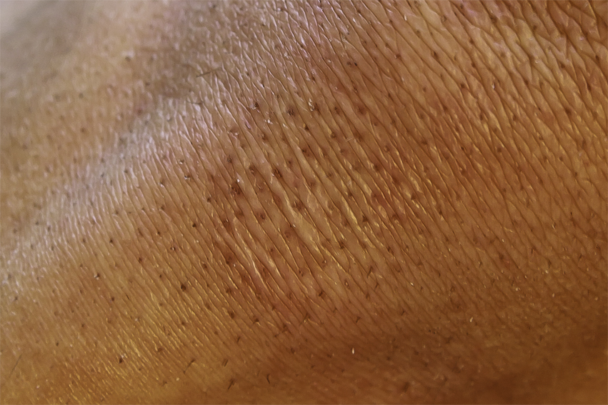 scar knee