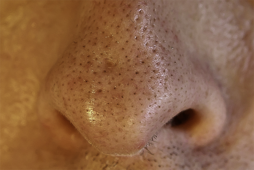 scar nose